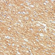 Formalin-fixed, paraffin-embedded human Brain Tumor stained with CD56 Monoclonal Antibody (123A8)