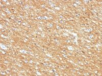 Formalin-fixed, paraffin-embedded human Brain Tumor stained with CD56 Monoclonal Antibody (123A8)