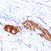Formalin-fixed, paraffin-embedded human Lung Carcinoma stained with CD56 Monoclonal Antibody (123C3.D5 + 123A8)