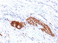 Formalin-fixed, paraffin-embedded human Lung Carcinoma stained with CD56 Monoclonal Antibody (123C3.D5 + 123A8)