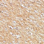 Formalin-fixed, paraffin-embedded human Lung Carcinomastained with CD56 Monoclonal Antibody (NCAM1/795)