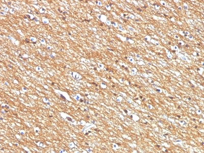 Formalin-fixed, paraffin-embedded human Lung Carcinomastained with CD56 Monoclonal Antibody (NCAM1/795)