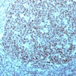 Formalin-fixed, paraffin-embedded human Testicular Carcinoma stained with Nucleolin Monoclonal Antibody (364-5 + NCL/92).