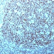 Formalin-fixed, paraffin-embedded human Testicular Carcinoma stained with Nucleolin Monoclonal Antibody (364-5 + NCL/92).