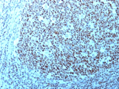 Formalin-fixed, paraffin-embedded human Testicular Carcinoma stained with Nucleolin Monoclonal Antibody (364-5 + NCL/92).