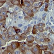 Formalin-fixed, paraffin-embedded human Melanoma stained with NGFR Monoclonal Antibody (NGFR5).