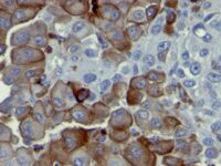 Formalin-fixed, paraffin-embedded human Melanoma stained with NGFR Monoclonal Antibody (NGFR5).