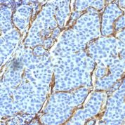 Formalin-fixed, paraffin-embedded human Melanoma stained with NGFR Monoclonal Antibody (SPM299).