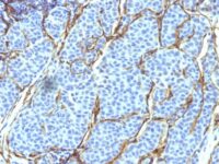 Formalin-fixed, paraffin-embedded human Melanoma stained with NGFR Monoclonal Antibody (SPM299).