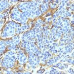 Formalin-fixed, paraffin-embedded human Melanoma stained with NGFR Monoclonal Antibody (NTR/912).