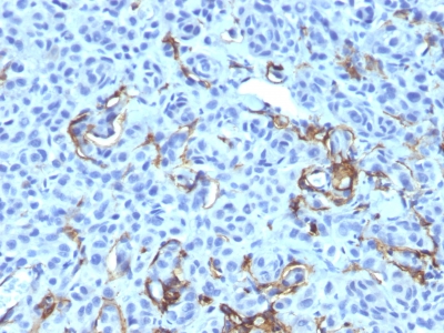 Formalin-fixed, paraffin-embedded human Melanoma stained with NGFR Monoclonal Antibody (NGFR5 + NTR/912).