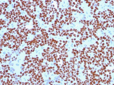 Formalin-fixed, paraffin-embedded human Pancreas stained with NKX2.2 Monoclonal Antibody (NX2/294).