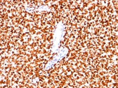 Formalin-fixed paraffin-embedded human Pancreas stained with NKX2.2 Monoclonal Antibody (SPM564).