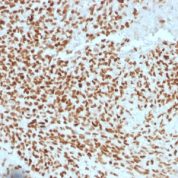 Formalin-fixed, paraffin-embedded human Ewing?s Sarcoma stained with NKX2.2 Monoclonal Antibody (NX2/1523).