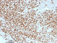 Formalin-fixed, paraffin-embedded human Ewing?s Sarcoma stained with NKX2.2 Monoclonal Antibody (NX2/1523).