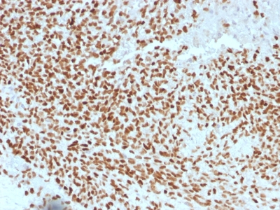 Formalin-fixed, paraffin-embedded human Ewing?s Sarcoma stained with NKX2.2 Monoclonal Antibody (NX2/1523).