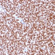 Formalin-fixed, paraffin-embedded human Ewing?s Sarcoma stained with NKX2.2 Recombinant Mouse Monoclonal Antibody (rNX2/294).