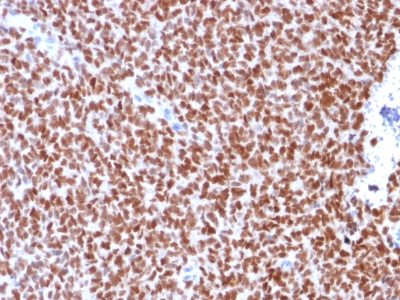 Formalin-fixed, paraffin-embedded human Ewing?s Sarcoma stained with NKX2.2 Recombinant Mouse Monoclonal Antibody (rNX2/294).