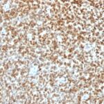 Formalin-fixed, paraffin-embedded human Ewings Sarcoma stained with NKX2.2 Recombinant Rabbit Monoclonal Antibody (NX2/1422R).