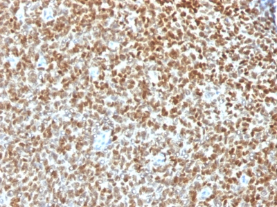 Formalin-fixed, paraffin-embedded human Ewings Sarcoma stained with NKX2.2 Recombinant Rabbit Monoclonal Antibody (NX2/1422R).