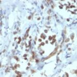 Formalin-fixed, paraffin-embedded human Gastric Carcinoma stained with PAX6 Monoclonal Antibody (PAX6/1166).