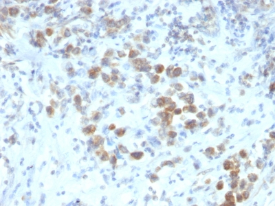 Formalin-fixed, paraffin-embedded human Gastric Carcinoma stained with PAX6 Monoclonal Antibody (SPM612).