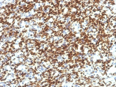 Formalin-fixed, paraffin-embedded human Testicular Carcinoma stained with PAX7 Monoclonal Antibody (PAX7/1187).