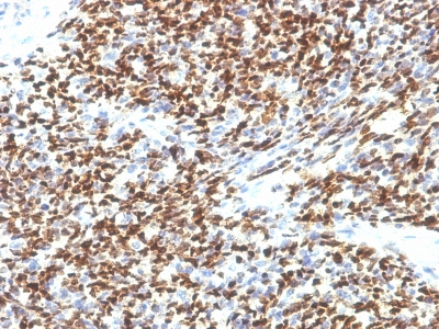 Formalin-fixed, paraffin-embedded human Rhabdomyosarcoma stained with PAX7 Monoclonal Antibody (SPM613).