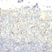 Formalin-fixed, paraffin-embedded human Testicular Carcinoma stained with FOXP3 Monoclonal Antibody (FXP3/197).