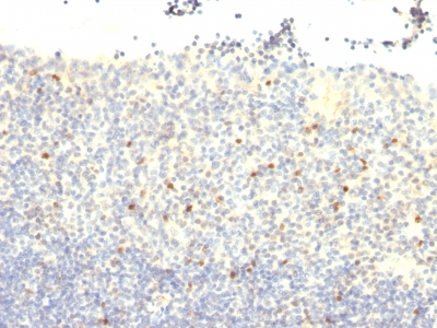 Formalin-fixed, paraffin-embedded human Testicular Carcinoma stained with FOXP3 Monoclonal Antibody (FXP3/197).