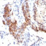 Formalin-fixed, paraffin-embedded human Testicular Carcinoma stained with FOXP3 Monoclonal Antibody (SPM579).