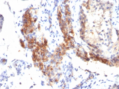 Formalin-fixed, paraffin-embedded human Testicular Carcinoma stained with FOXP3 Monoclonal Antibody (SPM579).