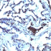 Formalin-paraffin human Prostate Carcinoma stained with TDP2 MAb (TDP2/1258)