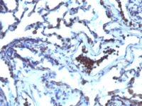 Formalin-paraffin human Prostate Carcinoma stained with TDP2 MAb (TDP2/1258)