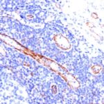 Formalin-fixed, paraffin-embedded human Angiosarcoma stained with CD31 Monoclonal Antibody (C31.3).