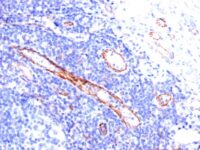 Formalin-fixed, paraffin-embedded human Angiosarcoma stained with CD31 Monoclonal Antibody (C31.3).