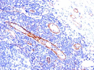 Formalin-fixed, paraffin-embedded human Angiosarcoma stained with CD31 Monoclonal Antibody (C31.3).