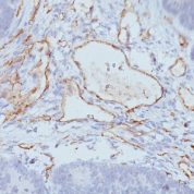 Formalin-fixed, paraffin-embedded Colon Carcinoma stained with CD31 Monoclonal Antibody (C31.3+C31.7+C31.1)