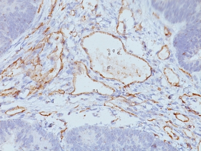 Formalin-fixed, paraffin-embedded Colon Carcinoma stained with CD31 Monoclonal Antibody (C31.3+C31.7+C31.1)