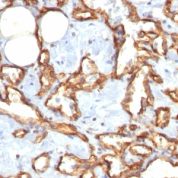 Formalin-fixed, paraffin-embedded human Angiosarcoma stained with CD31 Recombinant Rabbit Monoclonal Antibody (C31/1395R).