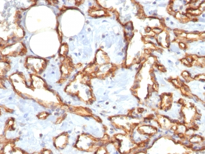Formalin-fixed, paraffin-embedded human Angiosarcoma stained with CD31 Recombinant Rabbit Monoclonal Antibody (C31/1395R).