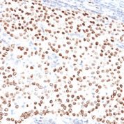 Formalin-fixed, paraffin-embedded human Breast Carcinoma stained with progesterone receptor Ab (PR5).