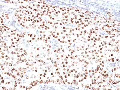 Formalin-fixed, paraffin-embedded human Breast Carcinoma stained with progesterone receptor Ab (PR5).