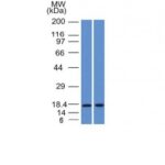 Formalin-fixed, paraffin-embedded human Breast Carcinoma stained with GCDFP-15 Monoclonal Antibody (PIP/1571).