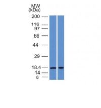 Formalin-fixed, paraffin-embedded human Breast Carcinoma stained with GCDFP-15 Monoclonal Antibody (PIP/1571).