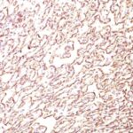 Formalin-fixed, paraffin-embedded human Angiosarcoma stained with Podocalyxin Monoclonal Antibody (4F1).