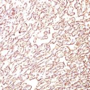 Formalin-fixed, paraffin-embedded human Angiosarcoma stained with Podocalyxin Monoclonal Antibody (4F1).