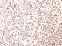 Formalin-fixed, paraffin-embedded human Angiosarcoma stained with Podocalyxin Monoclonal Antibody (4F1).