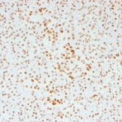 Formalin-fixed, paraffin-embedded human Pancreas Stained with ATRX Monoclonal Antibody (39f).