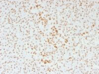 Formalin-fixed, paraffin-embedded human Pancreas Stained with ATRX Monoclonal Antibody (39f).